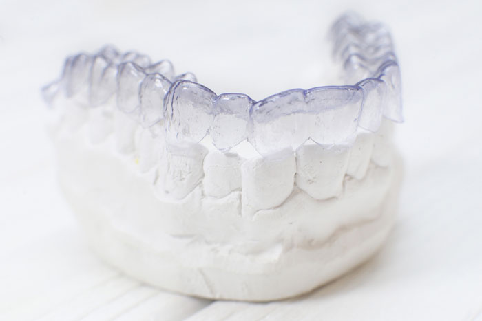 Invisalign top teeth clear braces